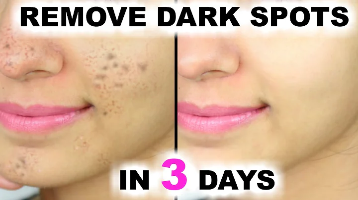 How can I remove dark spots in 5 minutes at home? (2023)